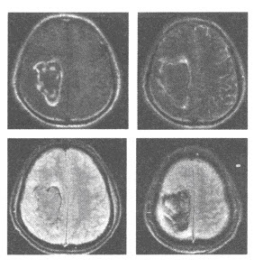 男性，66岁，因头痛、左侧肢体无力3天来诊。血压：165/95mmHg。颅脑MRI扫描如下图，应诊断