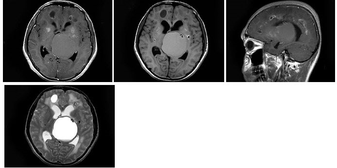 男，19岁，头痛、癫痫发作半年，头颅MRI平扫及增强扫描，最可能的诊断为（）