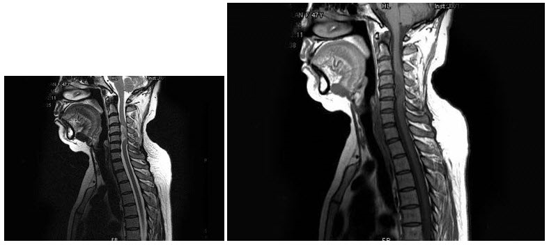 女，42岁，颈项部活动不利数月，上肢肌力稍差，头颅MRI见大脑镰旁脑膜瘤，颈髓MRI扫描如图所示应考