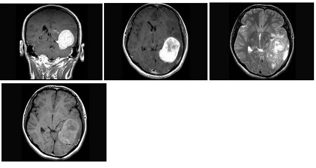 女，34岁，头痛数年，头颅MRI平扫及增强扫描，最可能的诊断是（）
