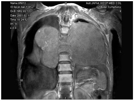 女，41岁，胸背部疼痛，肢体活动感觉障碍2年余，MRI检查见T7、T8椎体及附件骨质破坏，并向周围形