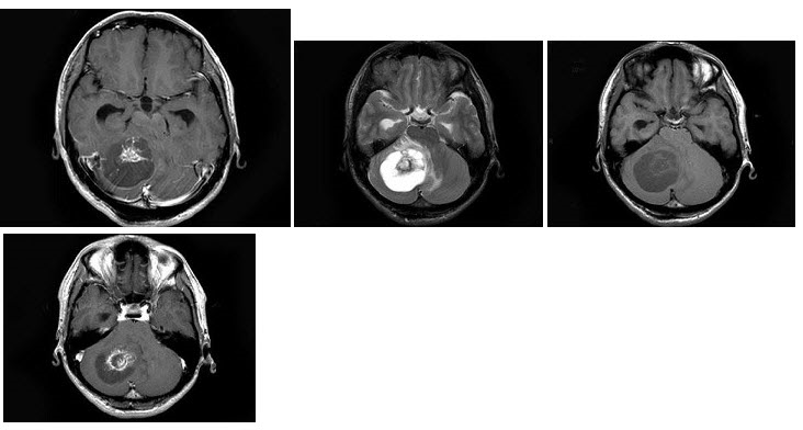 男，33岁，阵发性头痛伴呕吐行走不稳1个月，MRI平扫及增强扫描如图，最可能的诊断是（）