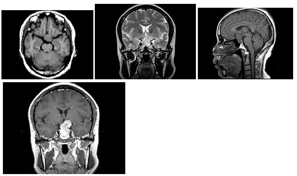 女，38岁，左侧视力下降伴头昏1个月余，根据所提供图像，最可能的诊断是（）