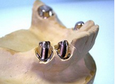 圆锥型套筒冠义齿内冠的设计下列说法哪项是错误的（）