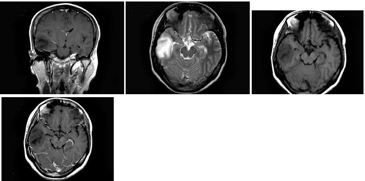 女，25岁，头痛3个月，头颅MRI平扫及增强扫描如图，最可能的诊断是（）