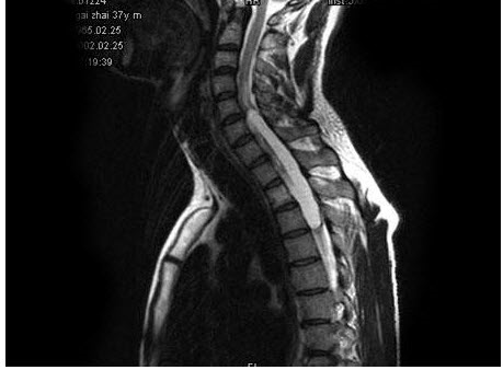 男，37岁，肢体活动不利、酸胀1年余，MRI扫描见椎管内长条形T1和T2高信号，脂肪抑制序列呈低信号