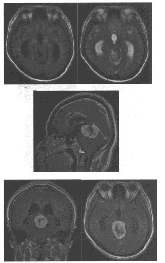 女，26岁，头痛1年，近1个月加重并伴复视。MRI平扫及增强扫描图像如下，最可能的诊断为（）