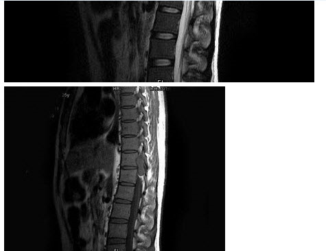 男，25岁，慢性腰痛伴间歇性跌倒半年，双下肢无力不能行走1月，MRI见下胸段椎管内肿瘤呈“哑铃”状应