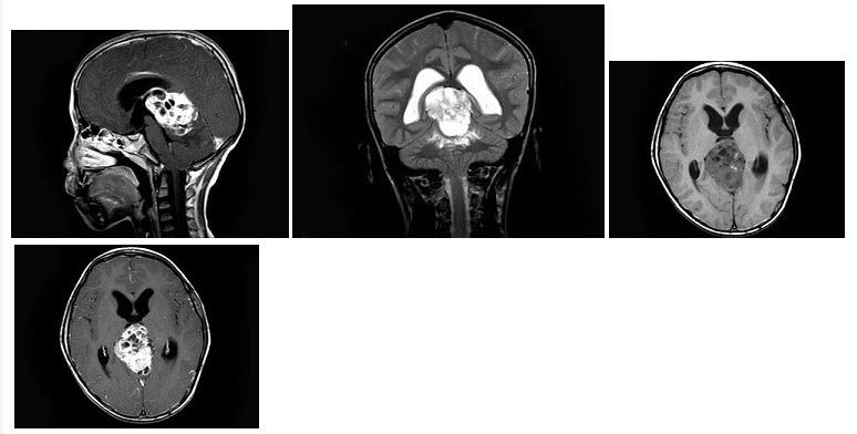 男，13岁，头痛半年，视力模糊数天MRI平扫及增强扫描如图，最可能的诊断是（）