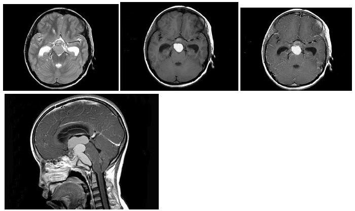 男，15岁，2个月前无明显诱因出现头痛，间断性钝痛，根据所提供图像，最可能的诊断是（）