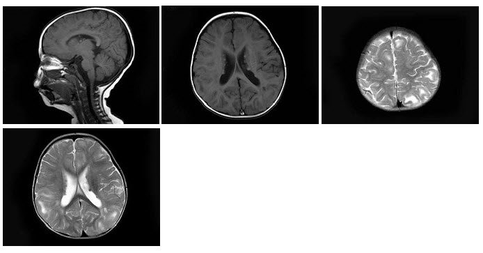 男，1岁，癫痫发作3次，智力反应低下，头颅MRI扫描如图，最可能的诊断为（）