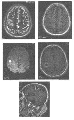患者，男性，62岁，左上肢肌力下降1周，颅脑MRI平扫和增强扫描图像如下，应首先考虑为（）