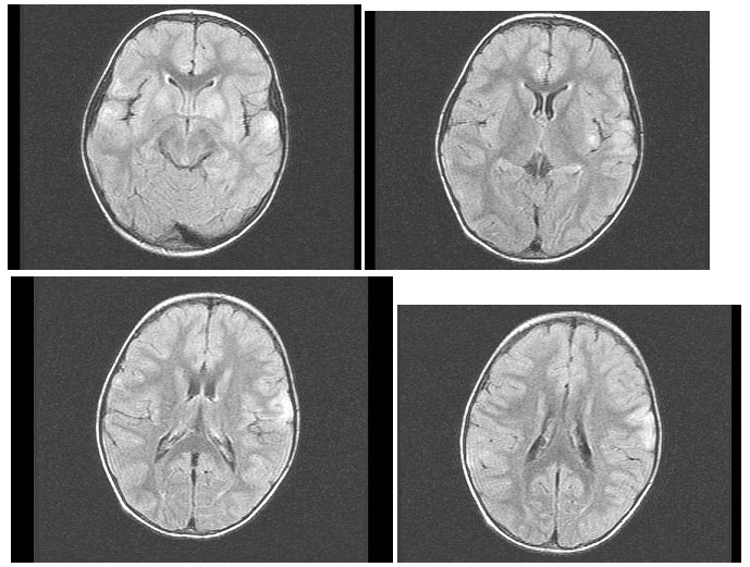女，3岁，头痛、呕吐1周，结合MRI图像，最可能的诊断是（）
