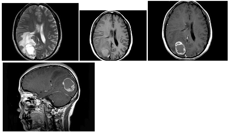 女，46岁，头痛、头昏半月入院，根据所提供图像，最可能的诊断是（）