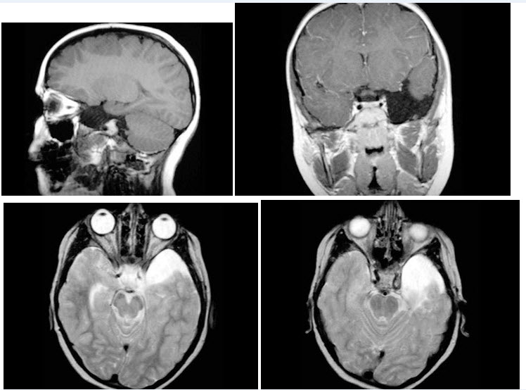 男，7岁，头痛，MRI表现如图，最可能的诊断是（）