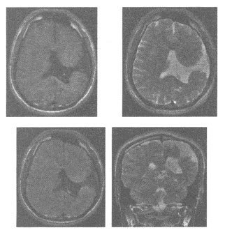 患者，男，25岁，颅脑MRI平扫图像如下，应诊断为（）