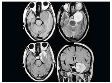 女，47岁，左侧面部麻木2个月余，伴阵发性头痛、耳鸣，MRI检查如图，最可能的诊断为（）