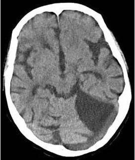 头颅MRIT1WI出现如图所示脑梗死，该病灶是下列哪两条血管供血区之间边缘带的局部缺血（）