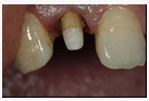 如果一成年人中切牙唇向倾斜，则以中切牙为基牙的固定桥设计时应采用（）