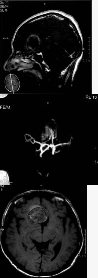 对于动脉瘤，下列那些是翼点入路的适应症？提示：该患者采用左侧翼点开颅夹闭动脉瘤（）