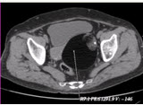 患者女，36岁，CT发现盆腔内囊实性肿块，以囊性为主，含脂肪和钙化（下图），诊断应首先考虑为（）