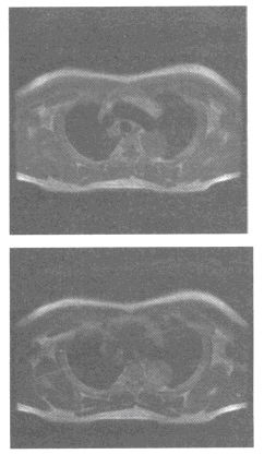 男，42岁，查体偶然发现左后纵隔占位，MRIT1WI、T1WI图像如下最可能的诊断为（）