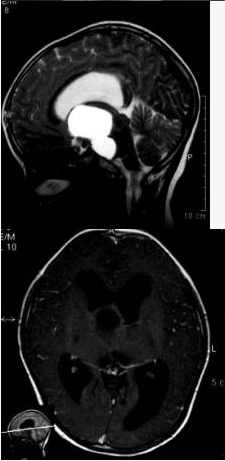 入院检查头部MRI，如图所示，诊断有可能是？（）
