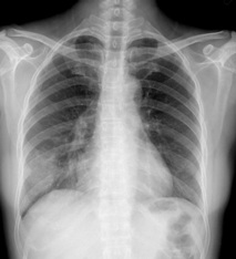 病历摘要：大叶性肺炎患者，女性，35岁，发热、咳嗽5天，咳嗽时伴有右侧胸痛。查体：右下肺可闻及湿啰音