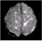 28岁男性，车祸外伤后昏迷，MRDWI示双侧半卵圆中心呈斑点样高信号影（下图），最可能的诊断是（）