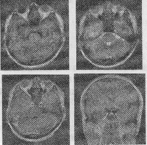 男，32岁，头痛1个月，头颅MRI平扫及增强扫描如图，最可能的诊断是（）