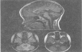 男，5岁，结合MRI图像，最可能的诊断是（）