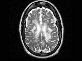女，56岁，有癫痫史，结合CT图像，最可能的诊断是（）