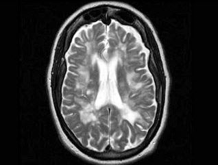 女，56岁，有癫痫史，结合CT图像，最可能的诊断是（）