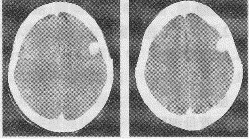 成年女性，头痛，增强CT图像如下，最可能的诊断为（）