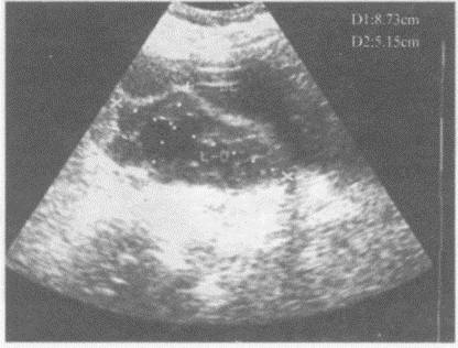 临床资料：女，40岁，自述下腹痛15天。妇科内诊：子宫左上方可扪及拳头大肿物，质中等，活动度差。超声