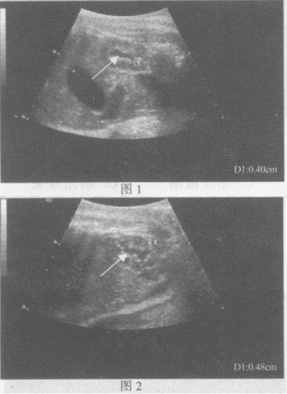 临床资料：女，37岁，孕28周。超声综合描述：胎儿腹部切面扫查，图1箭头所指宽度0．4cm形态不规则