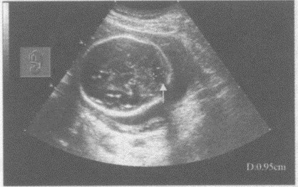 临床资料：女，37岁，孕30周。超声综合描述：胎儿颅骨光滑完整，脑中线居中，小脑延髓池宽0.95cm