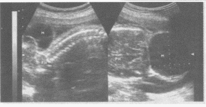临床资料：女，44岁，孕24周。超声综合描述：胎儿后枕部骨质缺损，可见5．5cm×4．8cm无回声向