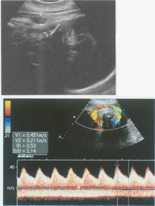 临床资料：女，31岁，孕38周。超声综合描述：胎儿颈部皮肤见"U"形压迹，CDFI：内见动静脉血流信