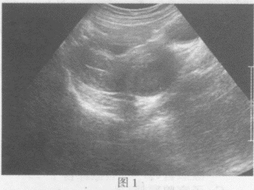 临床资料：女，32岁，自述不规则阴道出血半月余。超声综合描述：（图1经腹扫查；图2、彩图经阴道扫查）