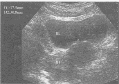 临床资料：女，49岁，常规体检。超声综合描述：子宫形态失常，宫体左侧可见3.7cm×3.1cm低回声