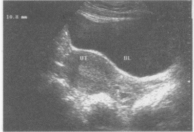 临床资料：女，32岁，常规体检。超声综合描述：子宫前位，形态大小正常，肌层回声均匀，子宫内膜居中。宫