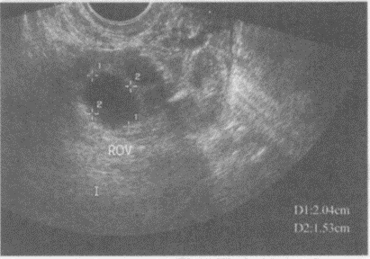 临床资料：女，27岁，自述月经周期第12天，行卵泡监测。超声综合描述：经阴道扫查右卵巢内可见2.0c