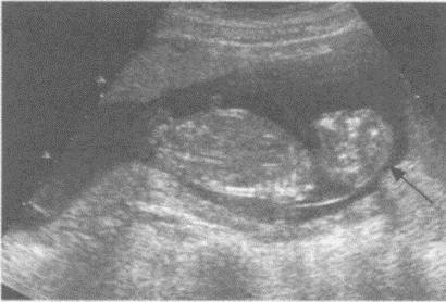 临床资料：女，29岁，孕18周。超声综合描述：缺少颅骨光环，胎头可见"瘤结"状块状物。超声提示（）