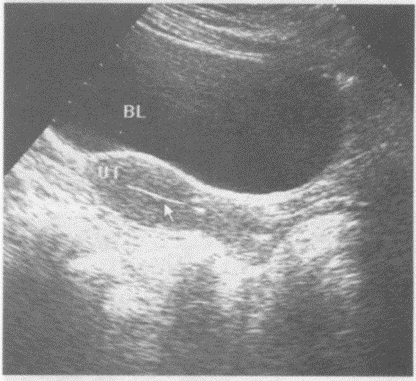 下图是子宫纵切超声图像，请回答箭头所指部位的解剖名称（）。