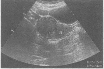 临床资料：女，40岁，常规体检。超声综合描述：子宫前位，宫底右前壁可见5．0cm×4．6cm稍低回声