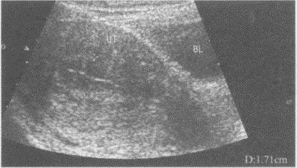 临床资料：女，30岁，自述月经量多不规律。超声综合描述：子宫水平位，形态大小正常，肌层回声均匀，宫腔