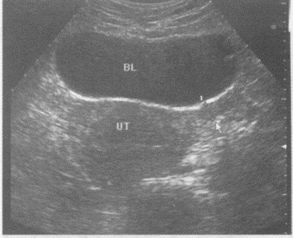 下图是子宫横切超声图像，请回答箭头所指部位的解剖名称（）。