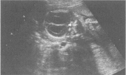 临床资料：女，32岁，孕21周。超声综合描述：颅骨未见明显扩大，双顶径与孕周相符，侧脑室扩大，内见无