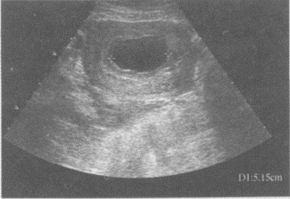 临床资料：女，32岁，孕14周。超声综合描述：子宫前位，小于孕周，肌层回声均匀，宫内见5.1cm×3